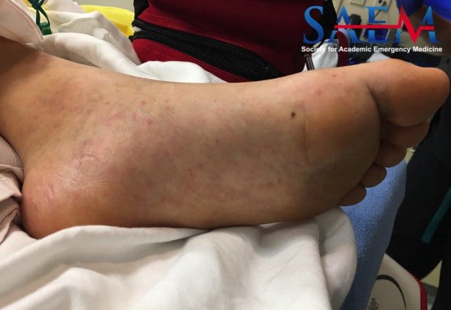 Rocky Mountain Spotted Fever foot petechiae