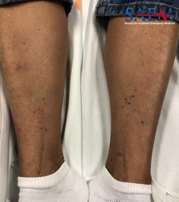 Rash fever