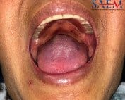 rash fever