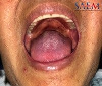rash dengue fever