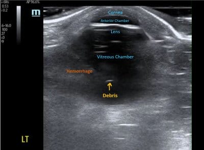 vitreous hemorrhage