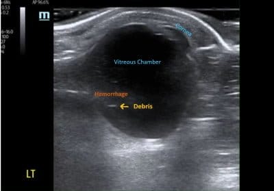 vitreous hemorrhage