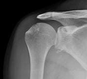 Image 4: Bony Bankart with concurrent Hill-Sachs Lesion Case courtesy of Dr Maulik S Patel, Radiopaedia.org.