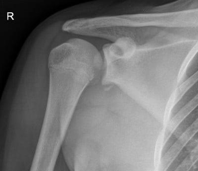 Bankart Lesion