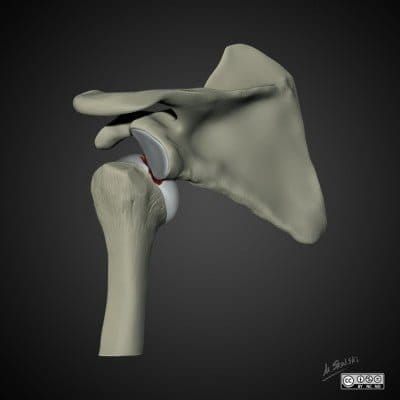 Image 3: Posterior view of Hill-Sachs Lesion in action Case courtesy of Dr Matt Skalski