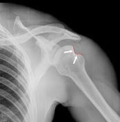 Hill-Sachs Lesion - Likely after multiple dislocations. Case courtesy of Dr Benoudina Samir,