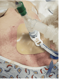 tracheostomy