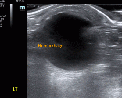 vitreous hemorrhage