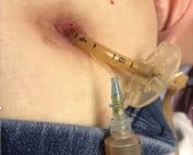gastrostomy tube g-tube