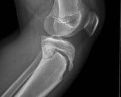 tibial tubercle fractures