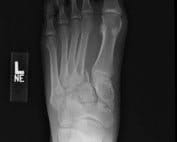 foot x-ray Lisfranc
