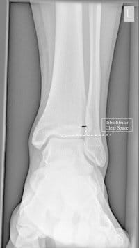 ankle x-ray syndesmosis ankle x-ray syndesmosis