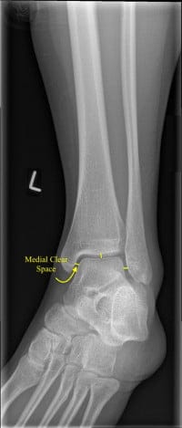 ankle x-ray mortise with medial clear space ankle x-ray mortise with medial clear space
