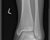 AP ankle radiograph