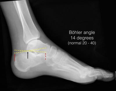 lateral ankle x-ray lateral ankle x-ray