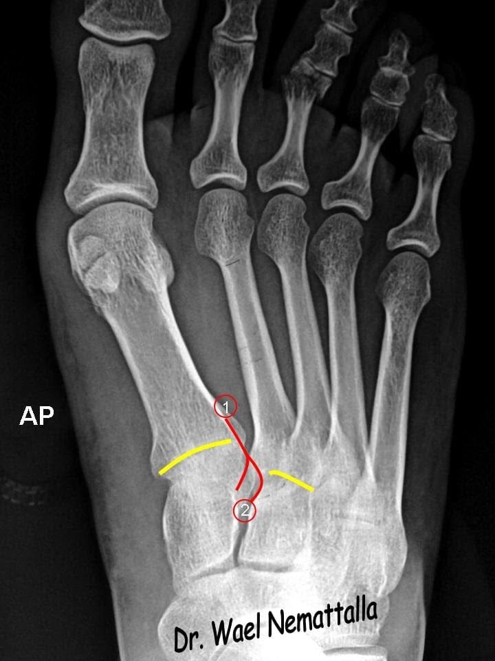 foot x-ray foot x-ray