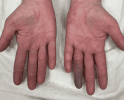 endocarditis