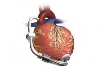 lvad