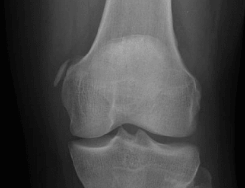 SplintER Series: Delayed pain in an injured knee