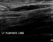 Plantaris Rupture LAX
