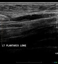 plantaris rupture