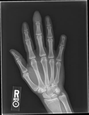 acute osteomyelitis