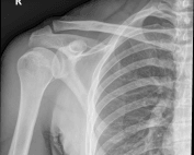 Normal-shoulder series