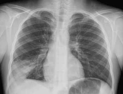 chest radiograph chest radiograph