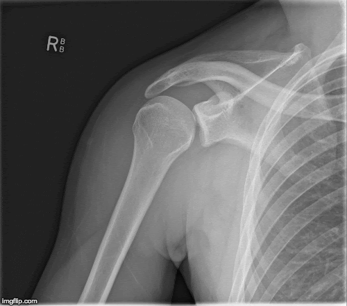 Posterior Dislocation AP