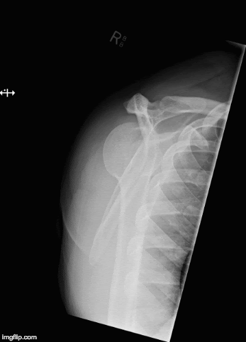 Posterior dislcoation spacula