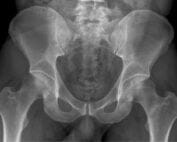 Femoral Neck Stress Fracture xray