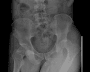 posterior hip dislocation xray
