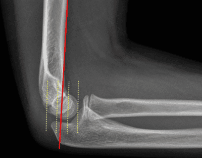 pediatric elbow