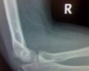 normal pediatric elbow