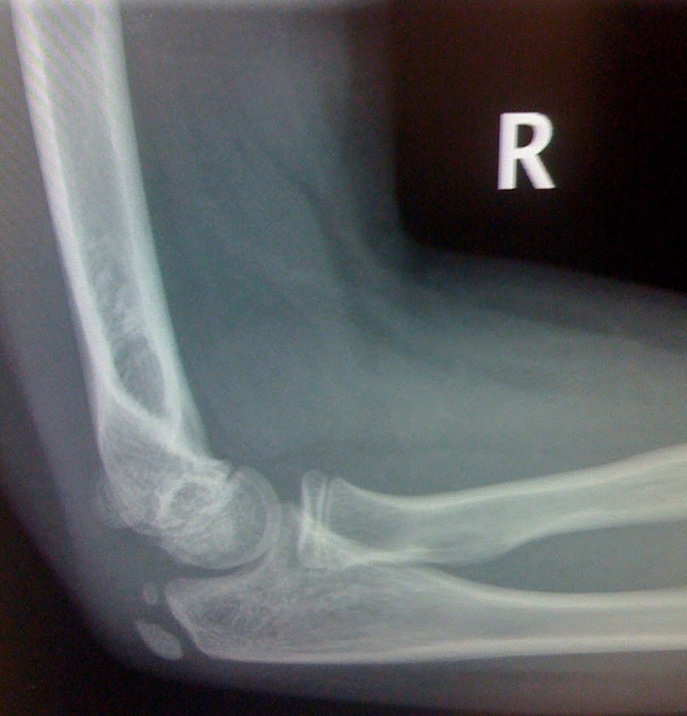 normal pediatric elbow
