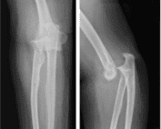posterior elbow dislocation xray
