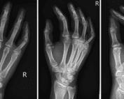 posterior shoulder dislocation xray