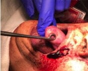 oropharyngeal mass