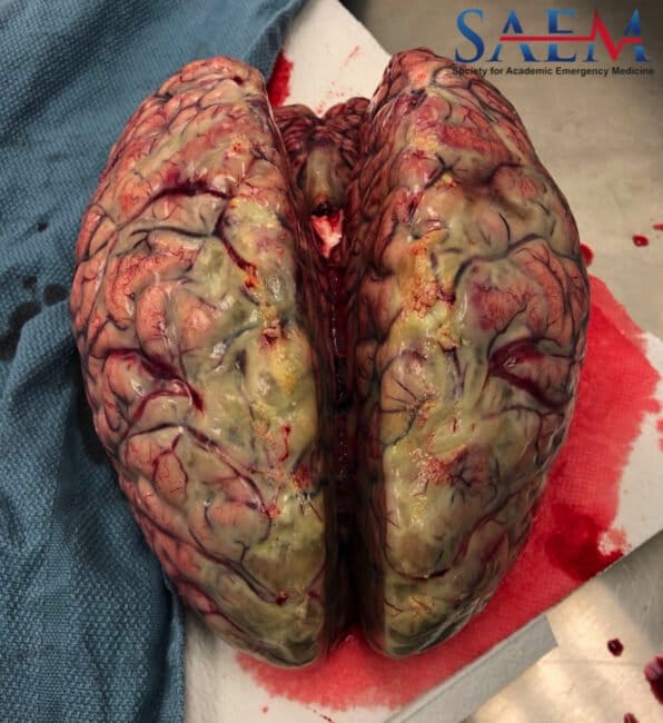 brain