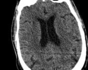Non-contrast CT
