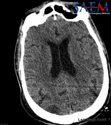 non-contrast head CT