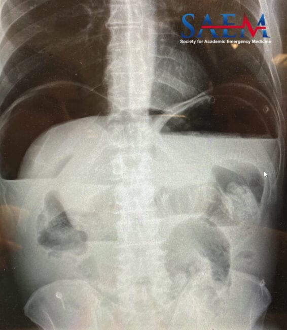 pneumoperitoneum