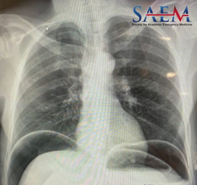pneumoperitoneum