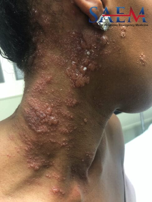 herpes zoster