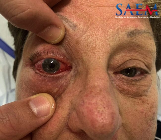 right eye conjunctiva
