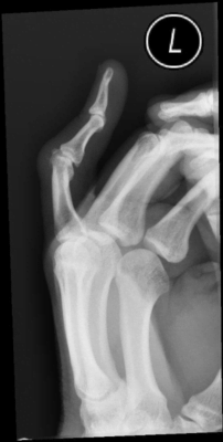 boutonniere deformity