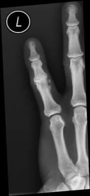 boutonniere deformity