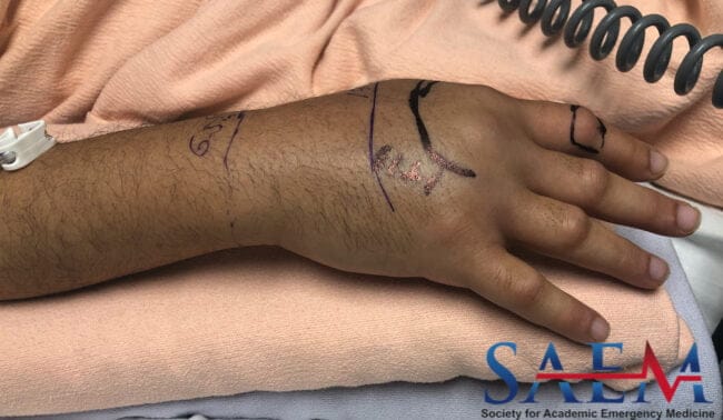 hand swelling