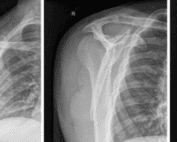 posterior shoulder dislocation xray