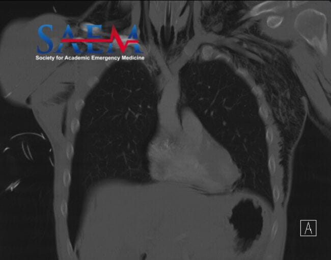 Computed tomography chest